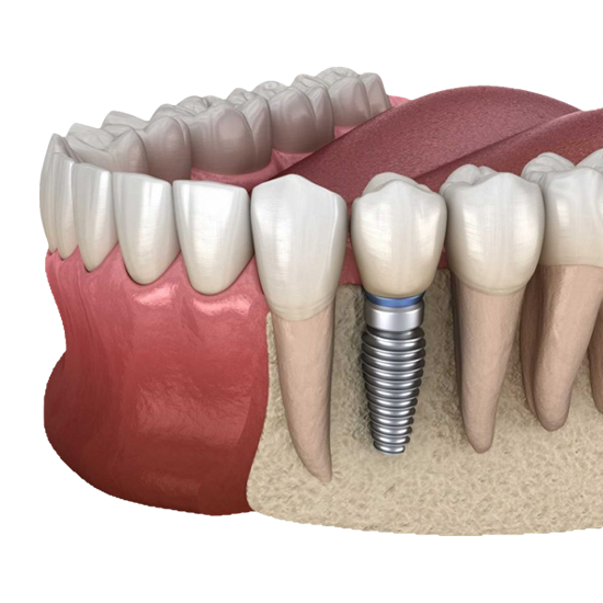klinik-post-modern-dental-implant-icerik
